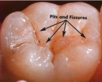 Fissures dentaires